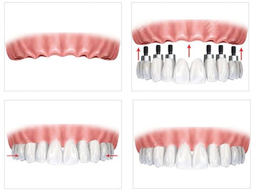 安徽种植牙价格变迁与时代影响概述